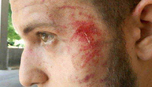 «Громадське ТБ. Запоріжжя» вимагає якнайшвидшого розслідування побиття журналіста Анатолія Остапенка