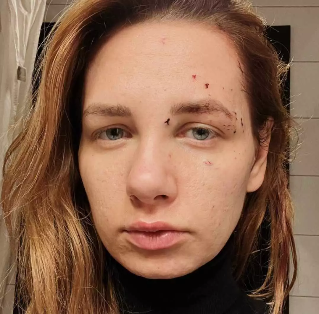 В обличчі фіксерки France 2 Віолетти Педорич, постраждалої 10 січня від російського обстрілу Харкова, застряг уламок скла
